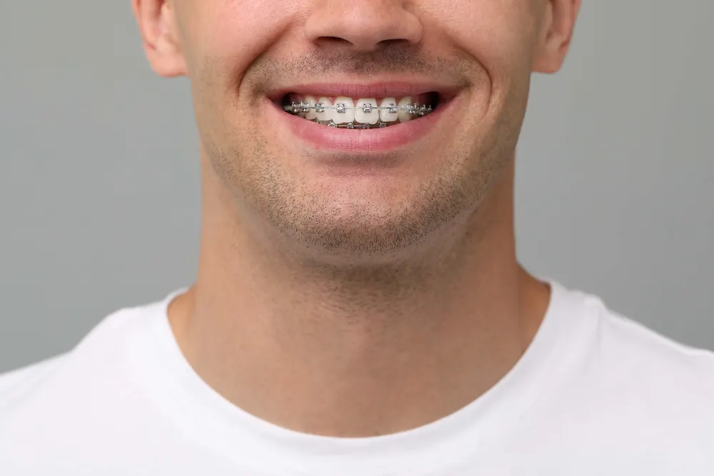 Close-up of a smiling mouth with fixed braces, brackets and archwire